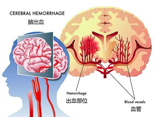 福建哪个医院的康复比较好? 脑梗塞后遗症的治疗方法?