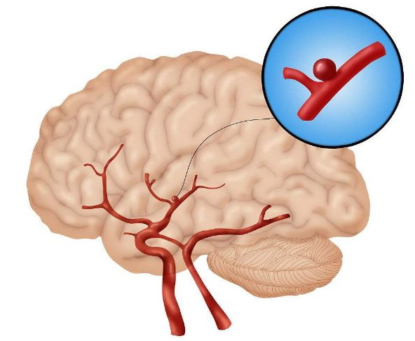 福州脑部血管狭窄怎么治疗?脑血管介入手术后遗症是什么?