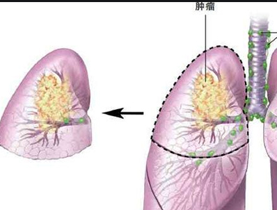 老人肺炎后总咳嗽怎么办