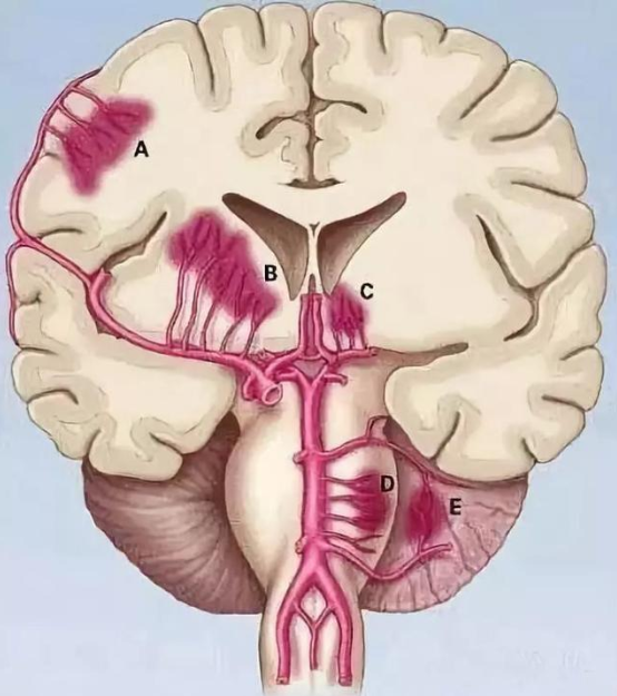 脑出血有哪些后遗症?有哪些康复锻炼方法