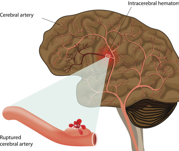 高血压脑出血是怎么回事