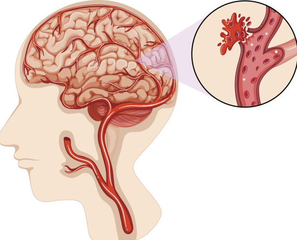 脑出血后遗症6年，瘫痪卧床能做神经训导康复治疗吗?